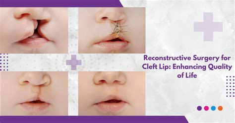 Reconstructive Surgery for Cleft Lip: Enhancing Quality of Life