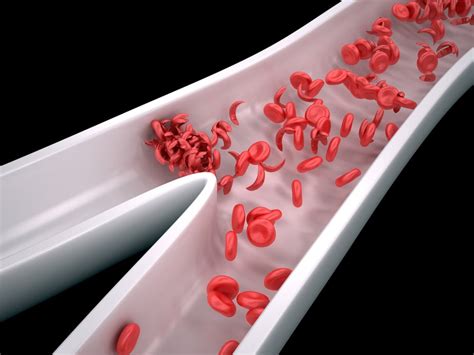 10 Symptoms of Sickle Cell Anemia - Facty Health