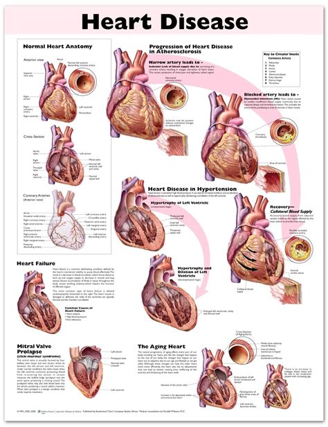 Heart Disease Chart / Poster - Laminated | Cardiología, Anatomía y Anatomia fisiologica