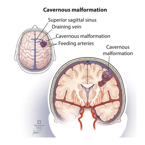 Cavernous Hemangioma: Symptoms, Treatment & Causes