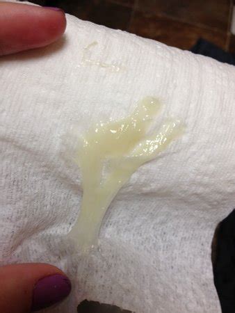 mucus plug or discharge? (photo) - Page 2 | BabyCenter