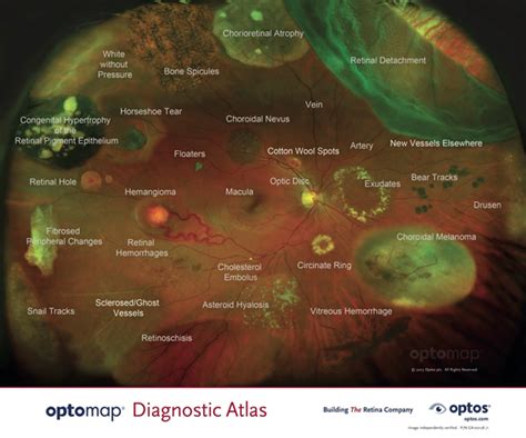 Optomap Havertown PA | Media PA