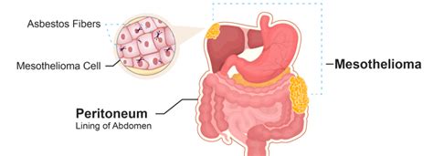 Peritoneal Mesothelioma | Symptoms, Treatment & Survival