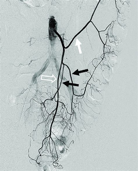 Inferior mesenteric angiogram for suspected active bleeding from a... | Download Scientific Diagram