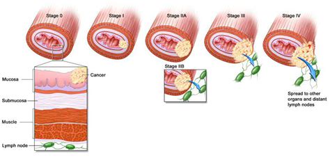 Bio Blabber: Throat Cancer