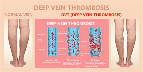 Blood Clot In Leg During Pregnancy Symptoms - PregnancyWalls