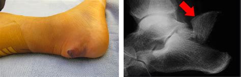 life after a calcaneus fracture surgery - Danelle Beaulieu