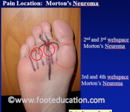 Morton's Neuroma - FootEducation