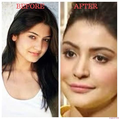 Anushka Sharma Lip Job Photos [Before & After] - Surgery4