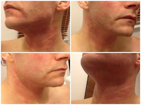 How To Treat An Allergic Reaction To Skin Care Products - Andy Millward - Facialist