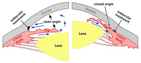 NARROW ANGLES - Toronto Eye Clinic