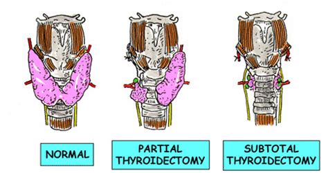 Thyroidectomy - Enlarged Thyroid