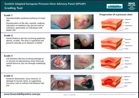 Scottish adaption of EPUAP guidelines for Pressure Injury grading | Wound care nursing, Wound ...