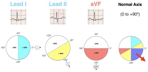 ECG Axis Interpretation • LITFL • ECG Library Basics