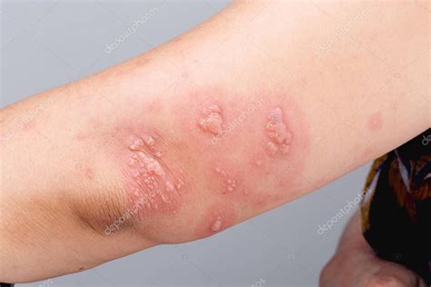 Shingles, Zoster or Herpes Zoster symptoms on arm — Stock Photo © toa55 #309326466