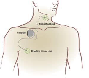 Hypoglossal Nerve Stimulation - Houston ENT Doctor