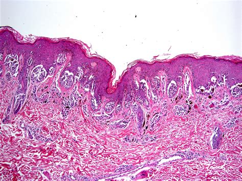 Compound Nevus Histology