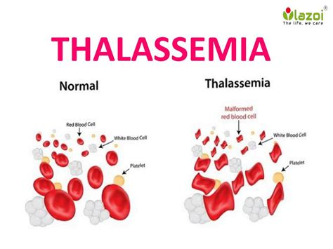 PPT - Thalessemia : Overview, Symptoms, complications, Risk factor, Causes, Daignosis and ...