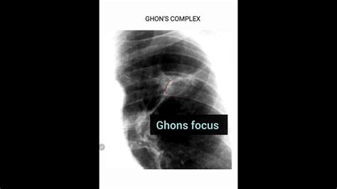 Ghon Focus | ghon lesion |Ghons complex | tuberculosis |tuberculoma| caseating granuloma| - YouTube