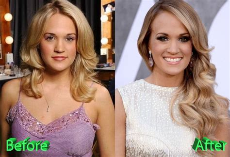 Carrie Underwood Plastic Surgery: Looking Better Than Ever