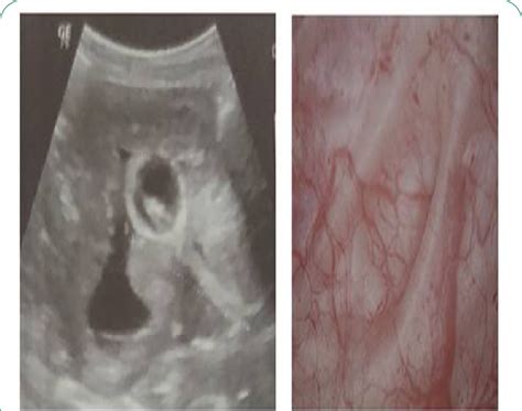 (A) Ultrasound urinary bladder show median lobe prostate. (B ...