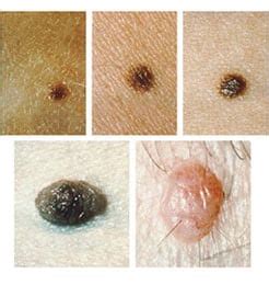 Atypical Moles vs Precancerous Moles vs Normal Moles | SERO