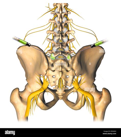 L5-S1 Bilateral Facet Injections Stock Photo, Royalty Free Image ...