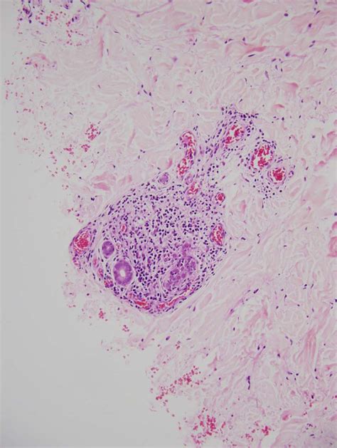 Lichen Striatus - Dermatology Advisor