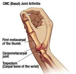 Basal Joint Arthritis - MD West One