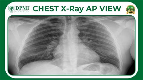 CHEST X-Ray AP View: What is Anteroposterior View in Radiology? Diagnostic Chest X-Ray ...