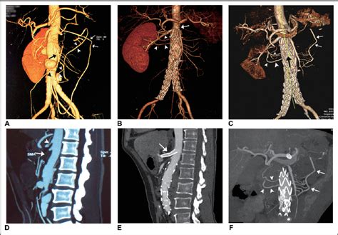 Celiac Artery Stenting in the Treatment of Intestinal Ischemia Due to ...