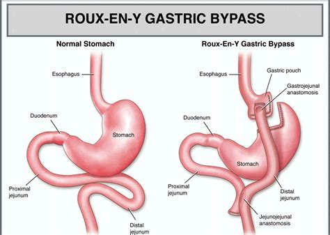 Gastric Anastomosis