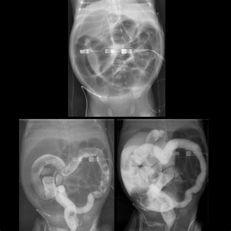 Ultrapremature newborn with massive abdominal distension who has passed ...