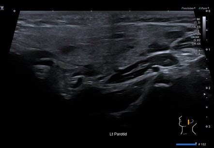 Juvenile recurrent parotitis | Radiology Case | Radiopaedia.org