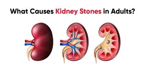 What Causes Kidney Stones in Adults? | Kidney Stones Clinic