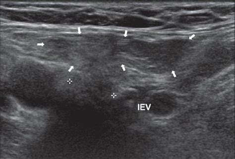 Pin em hernias- groin