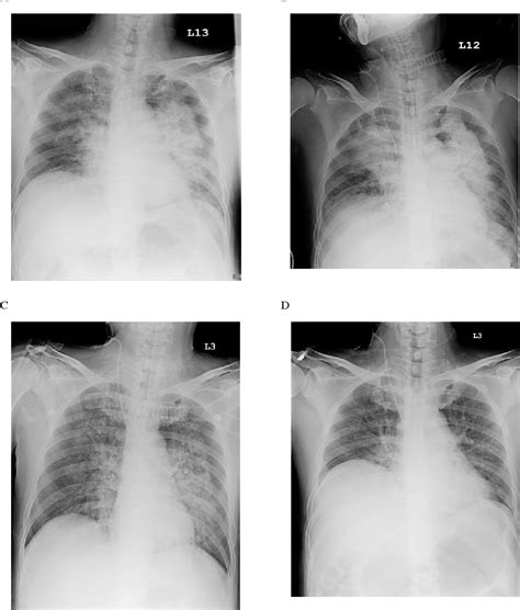 Figure 1 from High Altitude Pulmonary Edema: A Case Report | Semantic Scholar