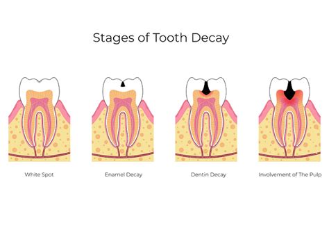 The Five Stages of a Cavity - Pediatric Dentistry - Pediatric Dental Center