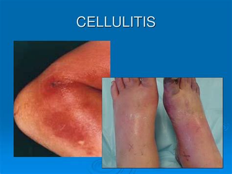 Cellulitis System Disorder Template