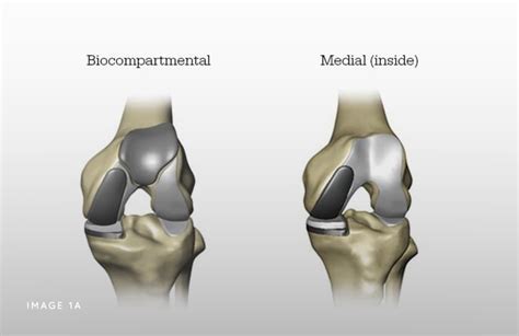 Mako Robotic-Arm Assisted Technology for Partial Knee Replacement - Ortho Illinois