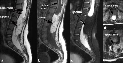 Preoperative lumbar MRI of the patient (a T2 sagittal, b T1 sagittal, c... | Download Scientific ...