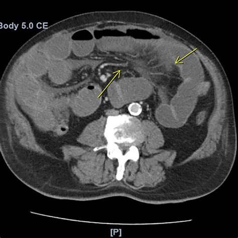 -Computerized tomography of the abdomen and pelvis with intravenous ...