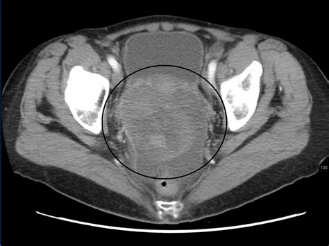 Ovarian Cancer | Geeky Medics