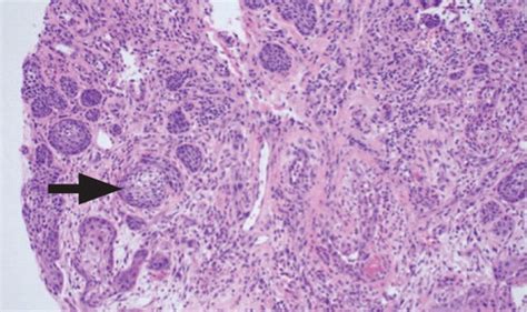 Necrotizing Sialometaplasia Histology