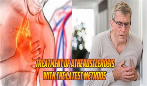 Atherosclerosis Treatment with the latest methods - Treatment of ...