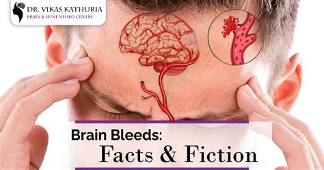 Brain Bleeds: Facts and Fiction Brain & Spine Neuro Center Blog