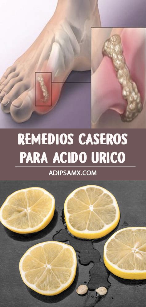 Remedios caseros para acido urico