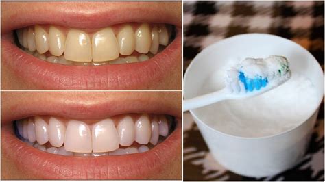 Teeth whitening at home Diy | Tooth sensitivity, Baking soda teeth, Teeth whitening