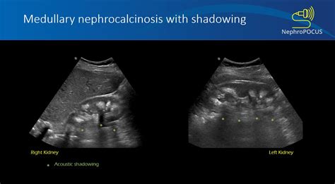 Medullary nephrocalcinosis – NephroPOCUS