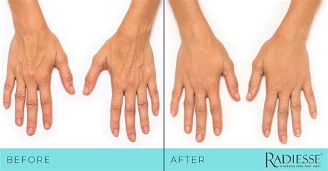 Hand Augmentation Before & After | Southeastern Dermatology